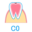 むし歯の段階・治療方法