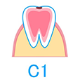 むし歯の段階・治療方法