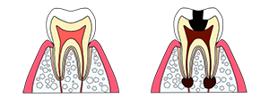 むし歯の段階・治療方法