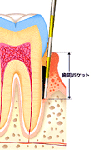 歯周病治療