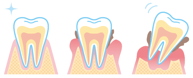 歯が失われる原因は？