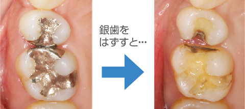 メタルフリーへの取り組み