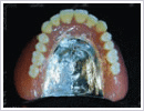 コバルトクロム製入れ歯